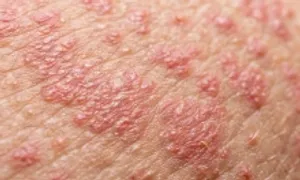 Vaccine thủy đậu có phòng được bệnh zona thần kinh?